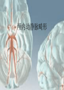 脑动静脉畸形