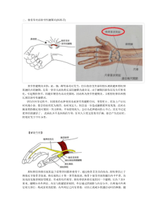 桡骨茎突部狭窄性腱鞘炎(妈妈手)