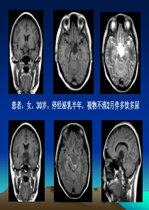 颅咽管瘤的影像诊断