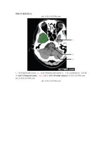 颅脑CT解剖