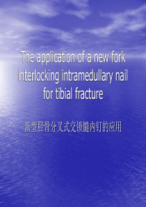 新型胫骨分叉式交锁髓内钉的应用