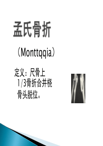 孟氏骨折与盖氏骨折