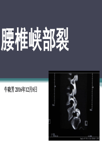 腰椎峡部裂
