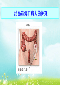 结肠造瘘口病人的护理