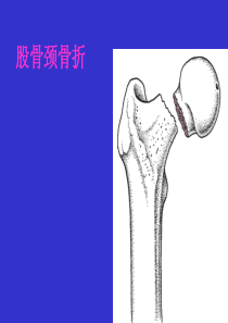 43股骨颈骨折