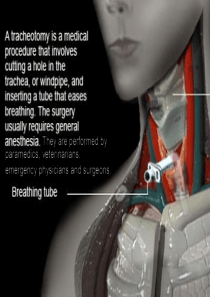 气管切开术(Tracheotomy)