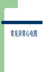 常见异常心电图