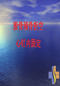 股骨颈骨折空心钉内固定选择