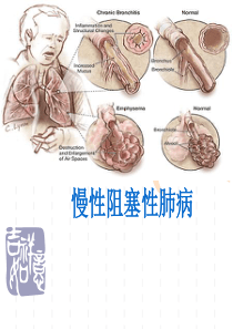 慢阻肺new.PPT2014.09.03
