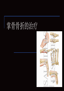 掌骨骨折的治疗