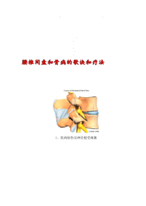 骨病疗法椎间盘