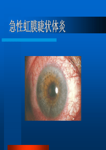 急性虹膜睫状体炎