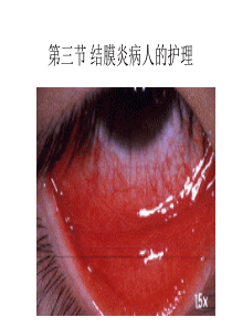 结膜炎病人的护理