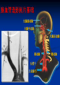 脑血管造影阅片