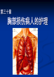 第三十章胸部损伤病人的护理