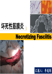 坏死性筋膜炎-Necrotizing-Fasciitis