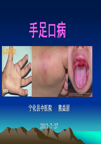 手足口病