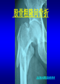 股骨粗隆间骨折