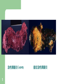 重症急性胰腺炎诊疗若干问题PPT精品文档43页