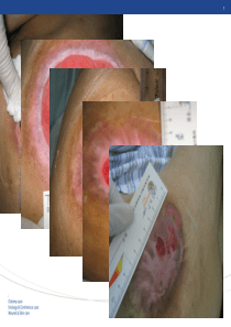 伤口基础理论知识