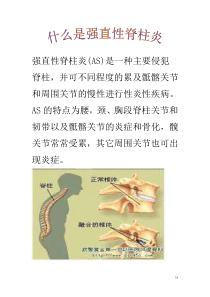 强直性脊柱炎健康宣教