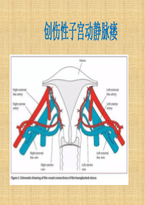 子宫动静脉瘘