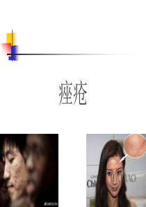痤疮(青春痘)的中西医治疗